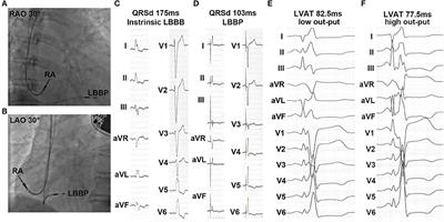 Cardiac resynchronization therapy in heart failure patients by using left bundle branch pacing